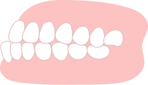 受け口（反対咬合）